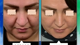 نمونه جراحی بینی با فاصله زمانی 6 ماه از عمل جراحی