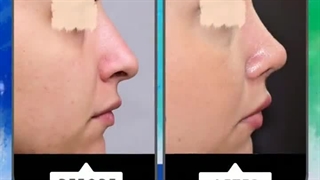 نمونه جراحی بینی ( 4 ماه بعد از عمل جراحی )