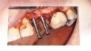 ️جراحی ایمپلنت دو دندان در فک بالا به همراه بازسازی استخوان با پی آر اف️