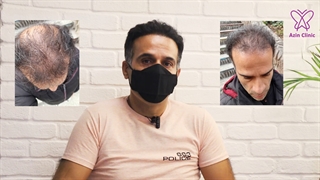 رضایت از کاشت مو