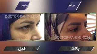 فیلم نمونه های بلفاروپلاستی