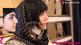 5 هفته بعد از عمل بینی با انحراف زیاد