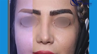 جراحی بینی  با نتیجه فوق العاده