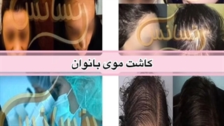 کاشت مو بانوان