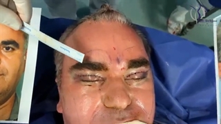 فیلم کامل جراحی لیفت صورت، پیشانی و پلک در اتاق عمل