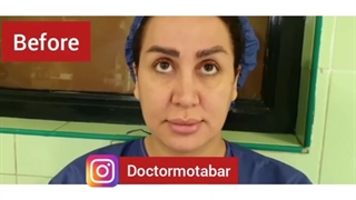 قبل و بعد عمل لیفت صورت
