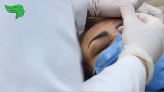 تزریق بوتاکس به پیشانی