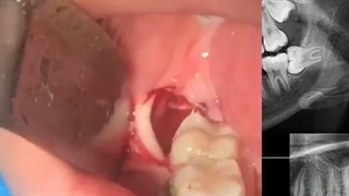 جراحی دندان عقل نهفته