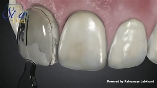 مراحل انجام لمینت کامپوزیتی