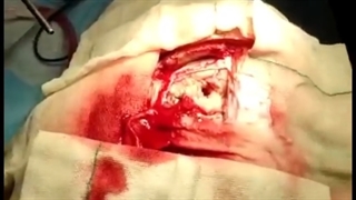 جراحی ضایعه در قسمت حرکتی مغز