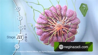 راهنمای پیشگیری از سرطان سینه
