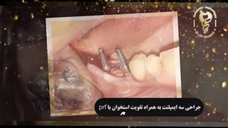 ️جراحی ۳ ایمپلنت به همراه تقویت استخوان با پی آر اف ️