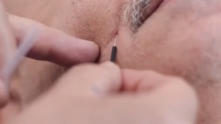 انجام طب سوزنی در صورت