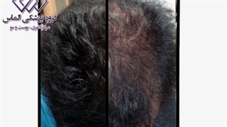 فیلم واقعی مزوتراپی موی سر