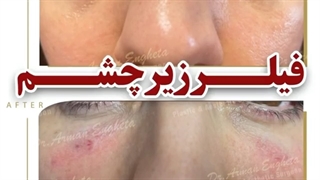 تزریق فیلر برای اصلاح گودی زیر چشم.