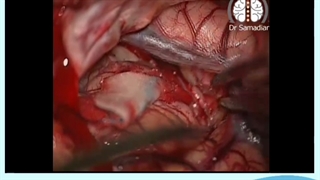 آنوریسم شریان مغزی میانی