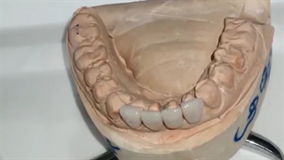 لامینت سرامیک