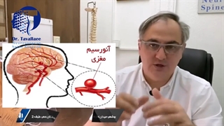 آنوریسم مغزی چیست؟