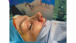 نتیجه جراحی زیبایی بینی
