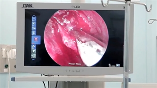 فیلم درمان گرفتگی بینی با جراحی