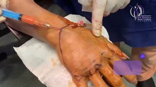 فیلم کامل لیفت اندوسکوپیک پیشانی و ابرو و تزریق چربی به دست لیفت ابرو