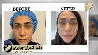 تزریق چربی به صورت تزریق بوتاکس