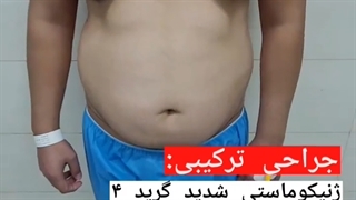 فیلم عمل ژنیکوماستی