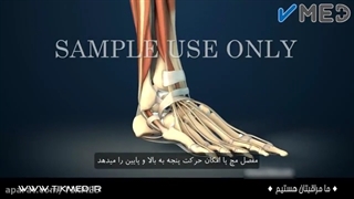 شکستگی مچ پا از شروع تا جراحی آن