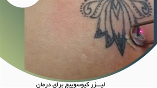 لیزر کیوسوئیچ