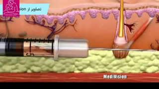 بوتاکس و ژل زیبایی از چه ساخته شده اند