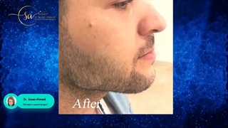 فیلم کامل زاویه سازی صورت با تزریق فیلر در مراجعه کننده آقا