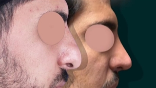 نمونه عمل بینی گوشتی