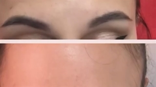 نتیجه بوتاکس