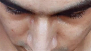 ویدئوی انجام عمل زیبایی بینی توسط خانم دکتر شیما حاجی بگلو دندانپزشکی کودکان