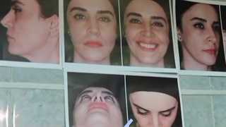 جراحی بینی با متقارن سازی سوراخ های بینی