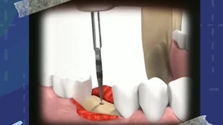 کاشت ایمپلنت دندان