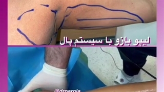 لیپو بازو با سیستم پال