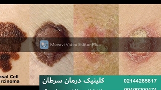 سرطان سلول سنگفرشی پوست