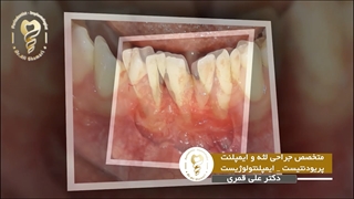 جراحی پیوند لثه در فک پایین پلاسماجت