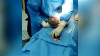 فیلم لیفت شکم همراه زایمان