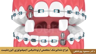 ارتودنسی و ایمپلنت