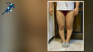 درمان زانوی پرانتزی| دکتر شیروانی بختیاری