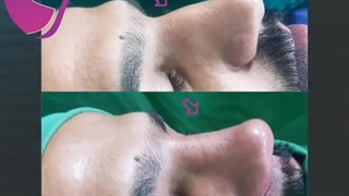 فیلم از نزدیک و اتاق عمل عمل بینی مردانه