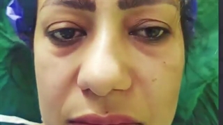 جراحی همزمان بینی و پلک