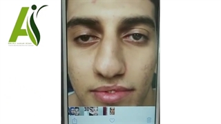 جراحی بینی مردانه