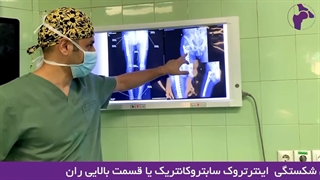 درمان جوش نخوردگی شکستگی قسمت بالایی ران