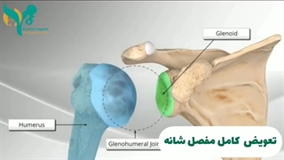 تعویض کامل مفصل شانه