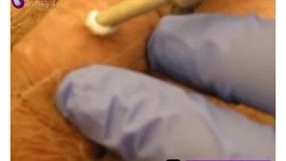 کرایوتراپی چیست؟