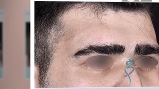 لیفت پیشانی