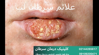 سرطان لب